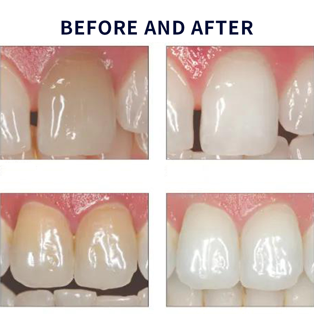 Opalescence Whitening 20% PF 2 - Teeth Whitening Home Kit recensione e prezzo