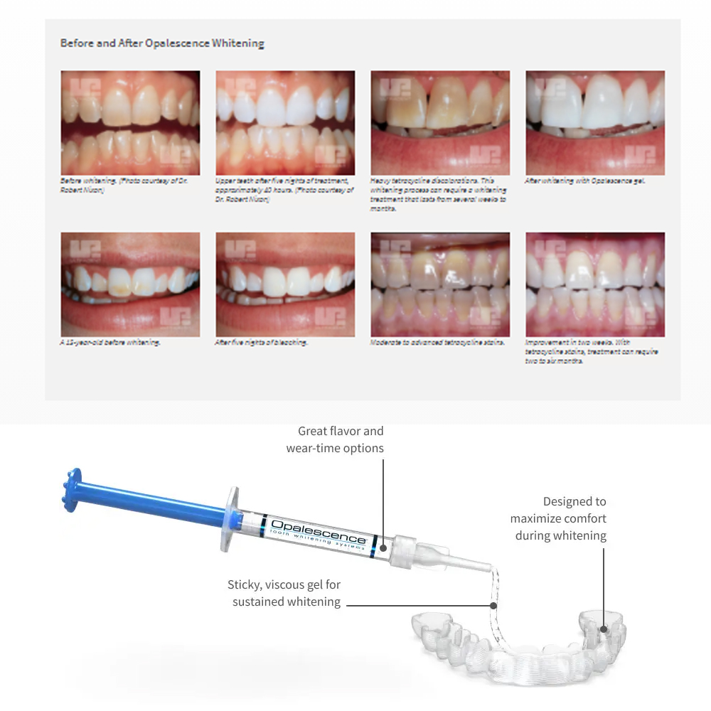 Opalescence Whitening 20% PF 2 - Teeth Whitening Home Kit recensione e prezzo
